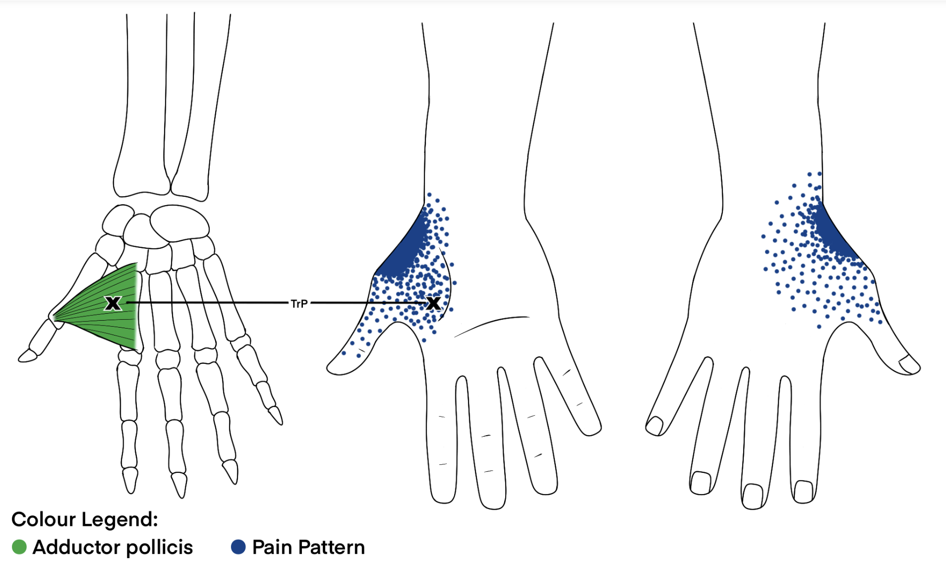 Adductor Pollicis image
