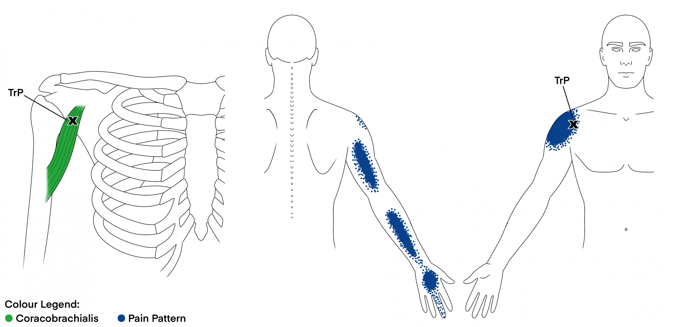 Coracobrachialis image